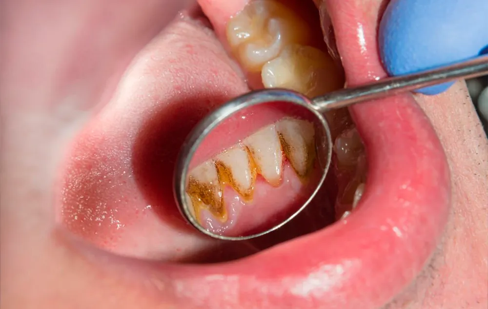 exploración de sarro en los dientes de un paciente mediante un espejo intraoral